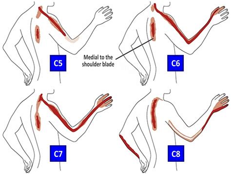 cervical radiculopathy compression test|cervical radiculopathy worse lying down.